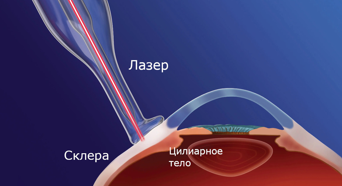 Транссклеральная лазерная циклокоагуляция при глаукоме в Москве