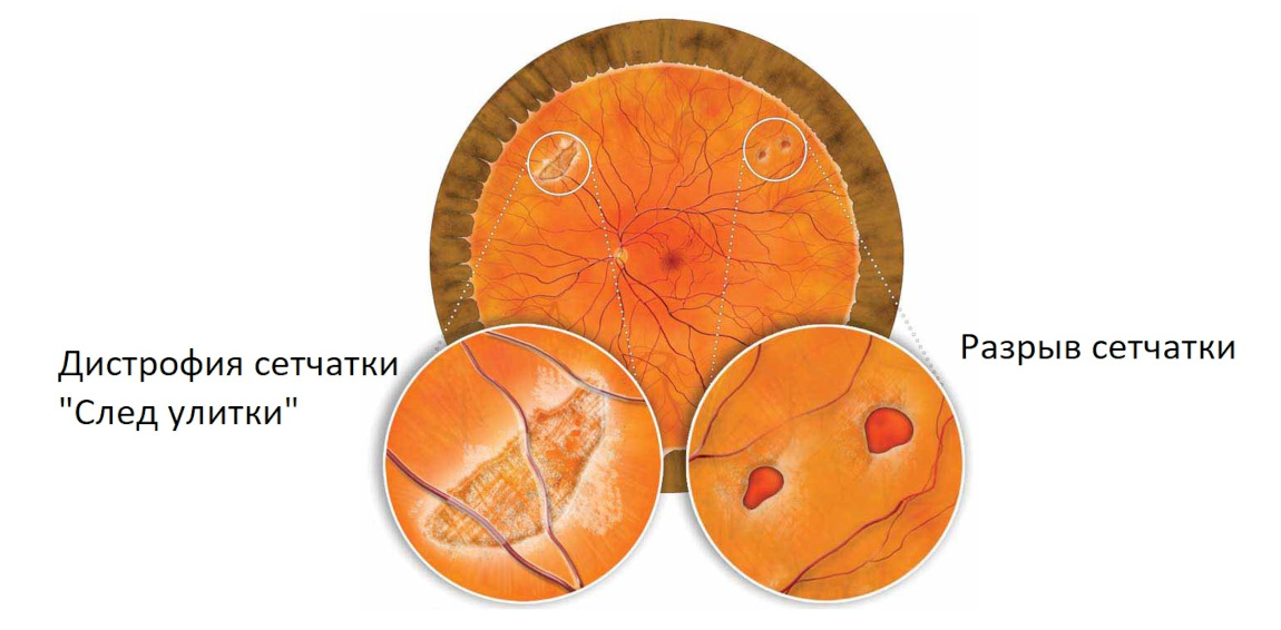 Дистрофия и разрыв сетчатки на глазном дне