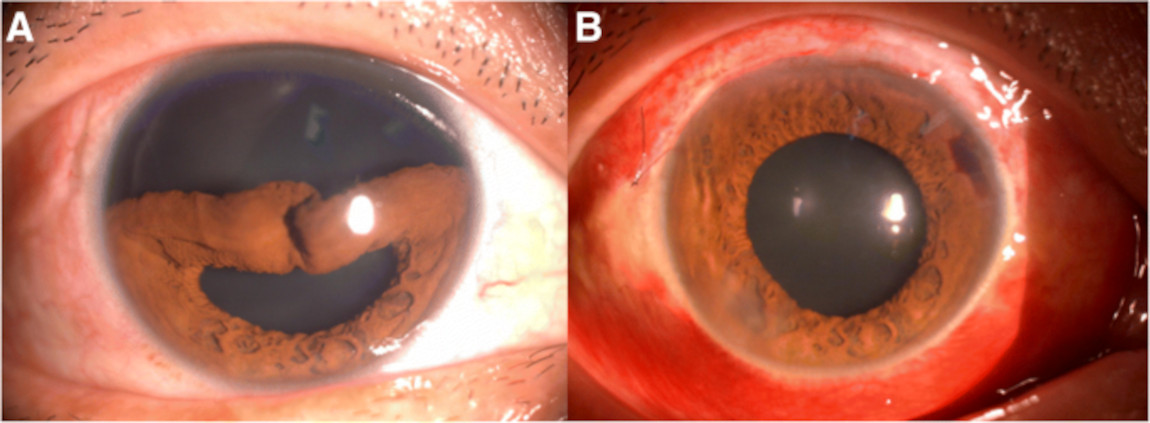 Травматический отрыв корня радужки: А - до лечения, B - после операции