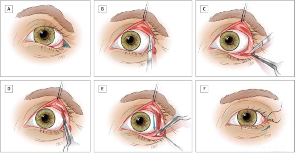 Один из вариантов оперативного лечения выворота нижнего века