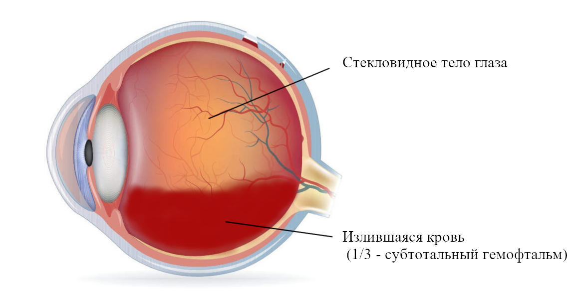 Гемофтальм глаза - лечение в Москвве