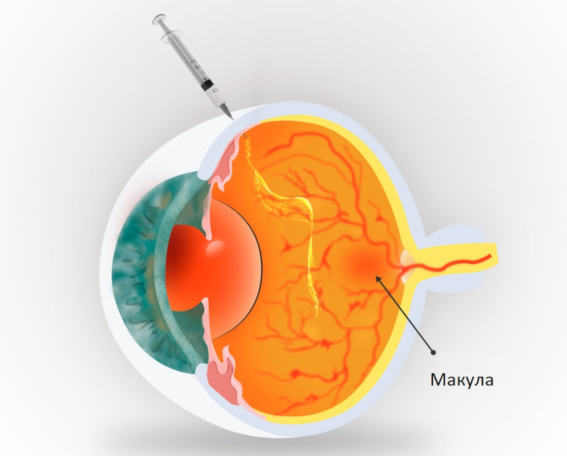 Схематическое изображение интравитреальной инъекции