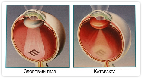 Лечение катаракты