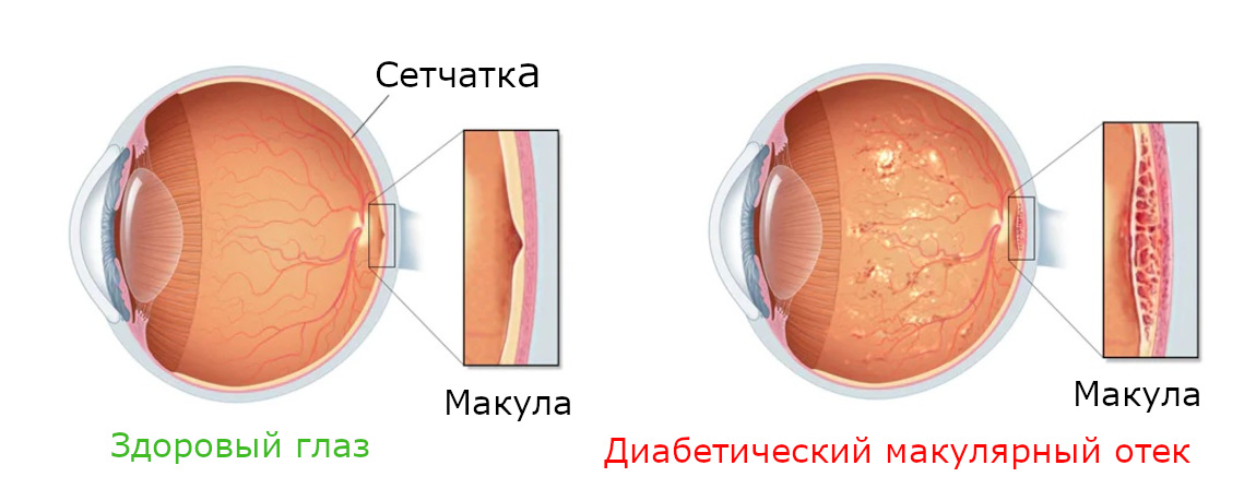 Лечение макулярного отека