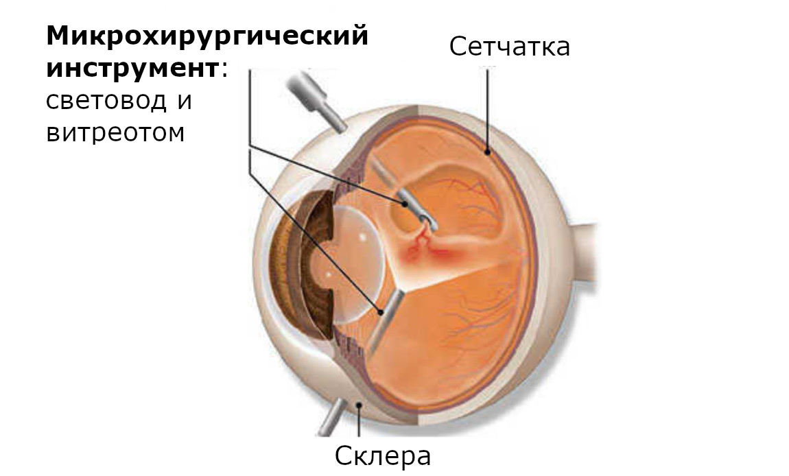 Схема микроинвазивной витрэктомии