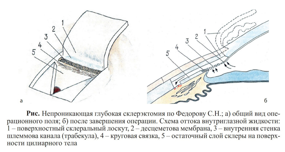 Схема операции непроникающей глубокой склерэктомии по Фёдорову