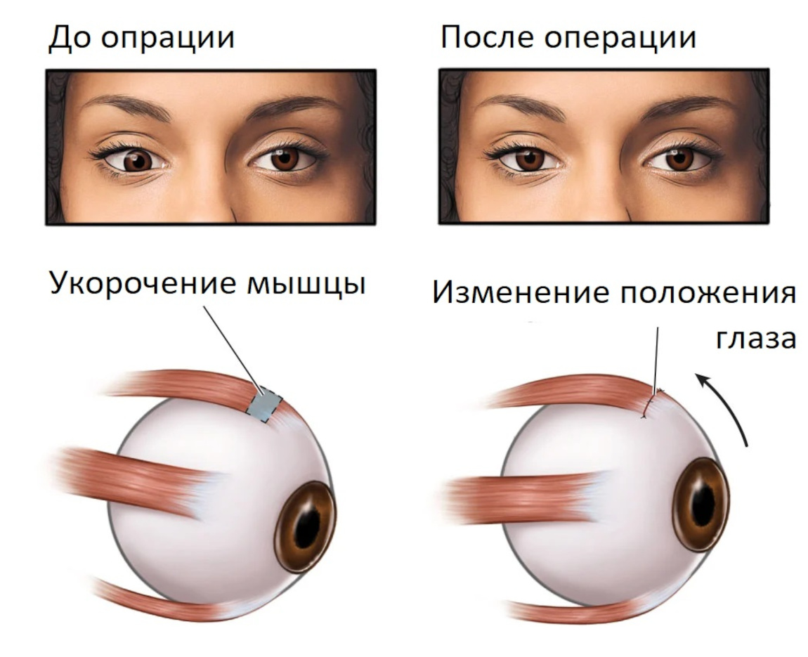 Принцип хирургии косоглазия