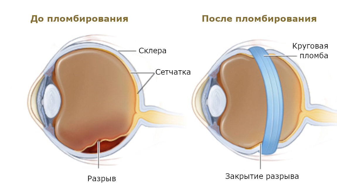 Схема кругового пломбирования склеры при разрыве