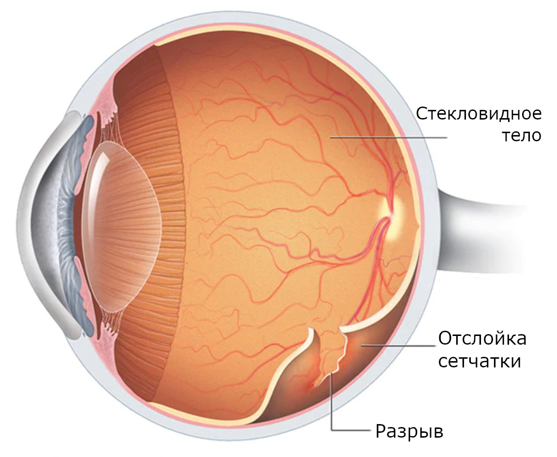Схематическое изображение разрыва и отслойки сетчатки