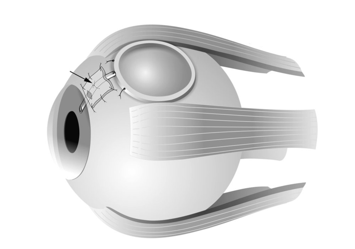 Схема устройства дренажа при глаукоме