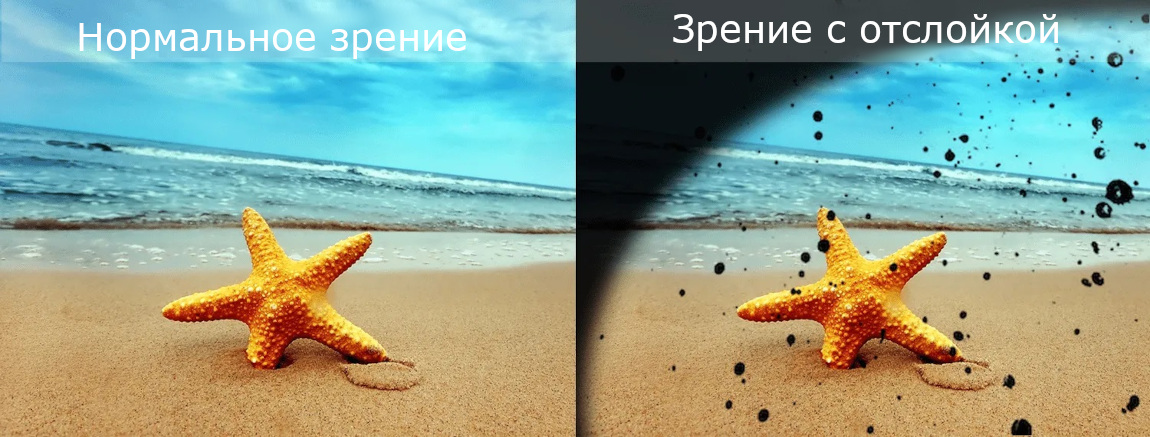 Зрение человека с отслойкой сетчатки